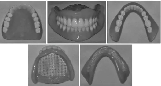 Fig. 4.  Final  complete  denture  with  glass fiber framework.