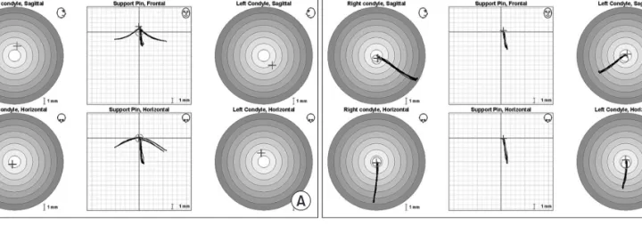 Fig. 3. Centric relation measurement by using Gothic arch method (A) and guided centric (B)