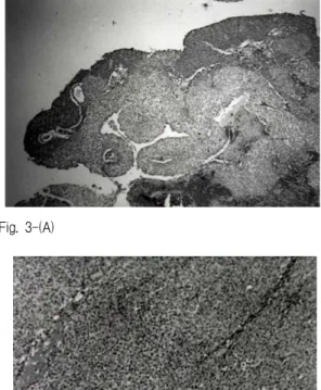Fig. 1. Contrast-enhanced CT scan shows a solid &amp;