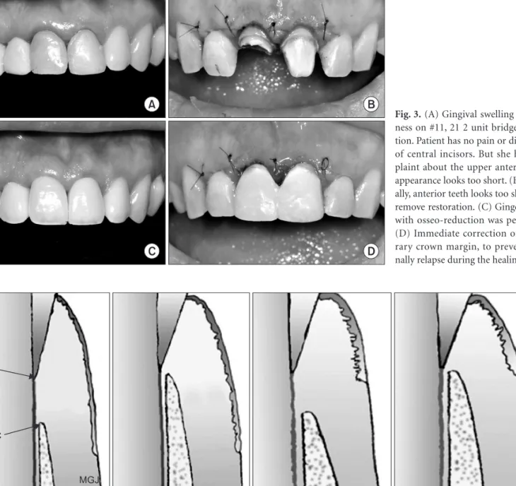 Fig. 4. Morphological classification of altered passive eruption (APE) according to Coslet et al