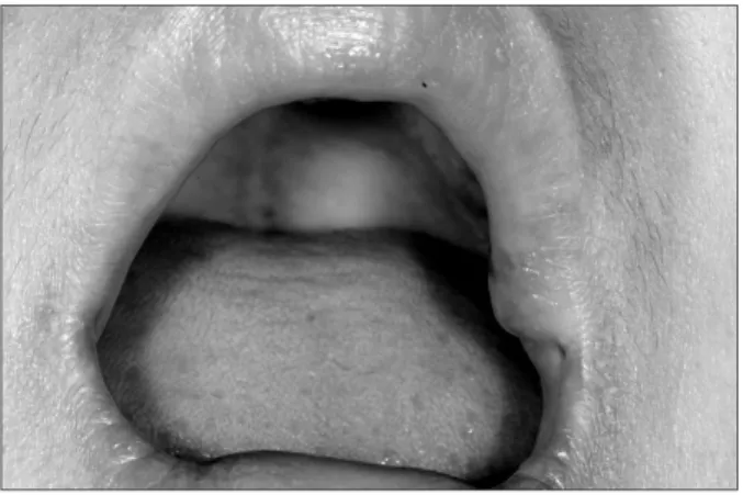 Fig. 4. Satisfactory result was observed without recurrence at four  months after final excision.
