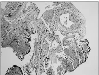 Fig. 5. Dilated lymphatic channels at subepithelial area (H&amp;E, ×100). 