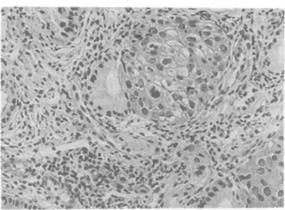 Fig 2. The s qua mous cell ca rcinoma in s itu with gla ndula r involve ment s hows pos itive re a ction for p53(P eroxida s e , DAB, ×200)