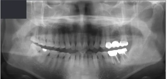 Fig. 3. Vertical ridge augmentation was performed using autogenous  tooth block at #36 area.