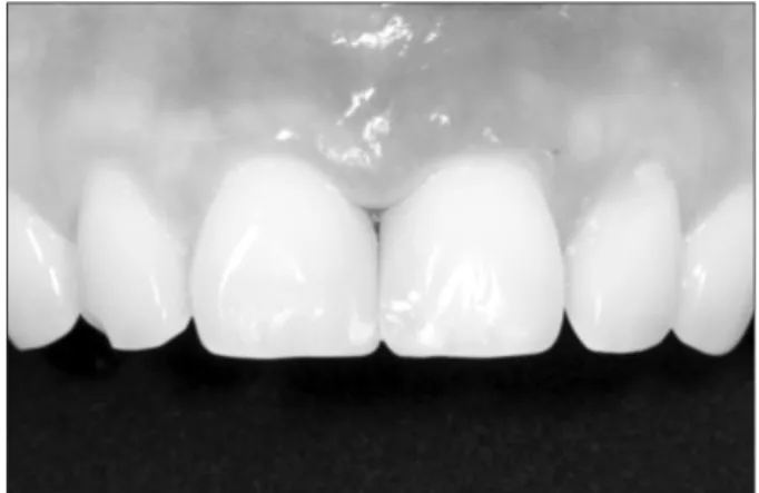Fig. 2. (A) Bony defect of buccal side  after #21 extraction. (B) Subepithelial  tissue split