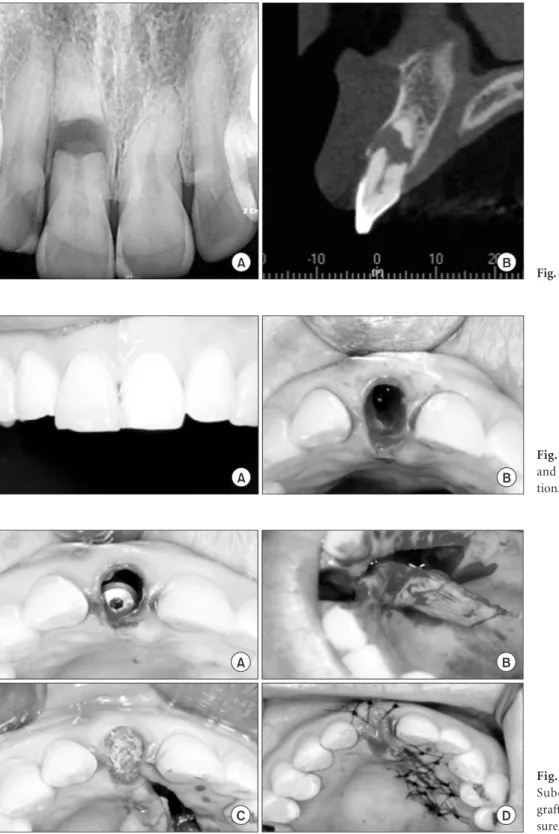 Fig. 7. Vertical clinical pre-operative  and Horizontal view after #11  extrac-tion.