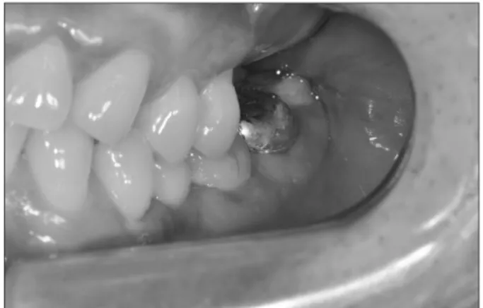 Fig. 4. This is a crown photograph of the left mandibular second mo- mo-lar on the model