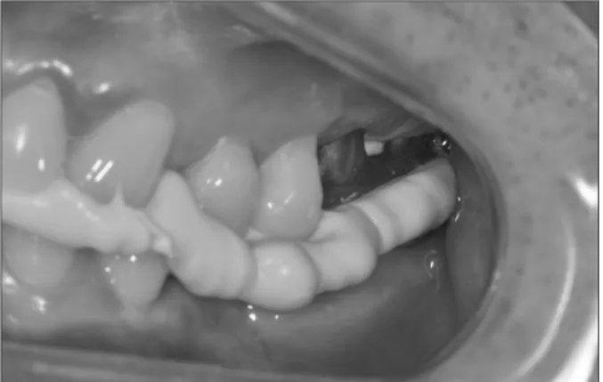 Fig. 7. This is a clinical photograph after impression coping place- place-ment.