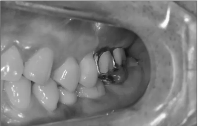 Fig. 14. This is a radiograph after the fi nal prostheses. Standard view. 