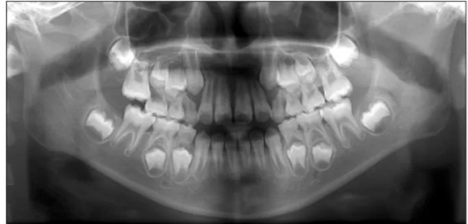 Fig. 1. Pre-treatment panoramic view. Right maxillary first molar  mesially locked at the distal cervix of second primary molar and  re-sorption of distal root of second primary molar were observed.