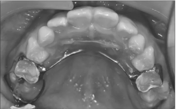 Fig. 4. Eight weeks after delivery. The overcorrection of 1 mm was  observed. The power chain and lingual button were removed.