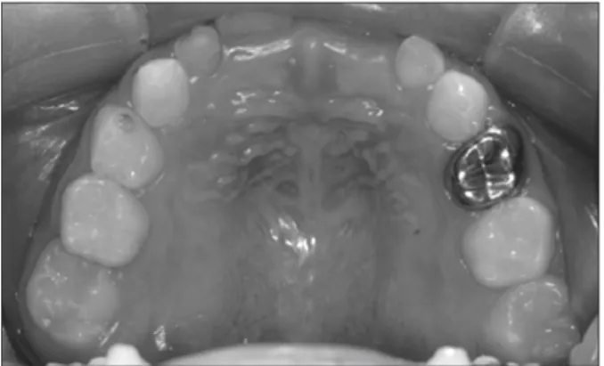 Fig. 12. After 6 months, the appliance and composite resin were re- re-moved.