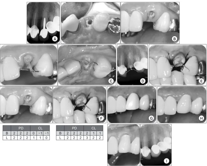 Fig. 2. (A) Radiograph at the fi rst visit showing radiolucent gap between the upper prosthodontics and root rest of #22 tooth