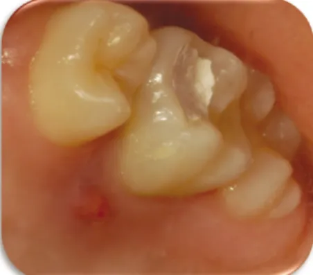 Figure 2. Pre-operative periapical x-ray. Figure 3. Pre-operative conebeam CT image. CT, computed tomograph.