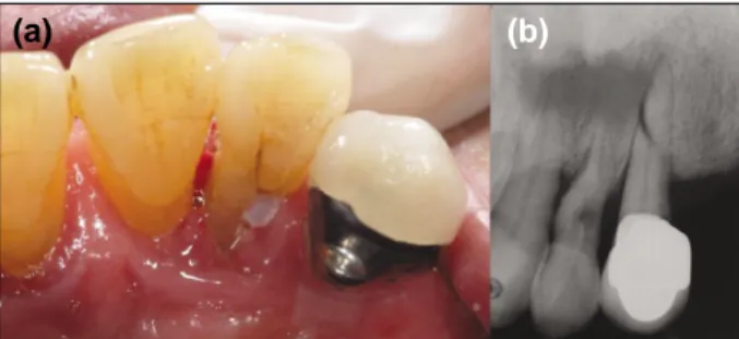 Figure 6. Caries  treatment  of  palatogingival  groove  with conventional root canal therapy.