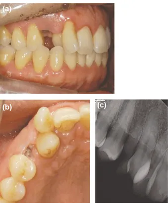 Figure 2. Orthodontic  treatment:  The  movement  of  the canine to first premolar was failed (a - c).