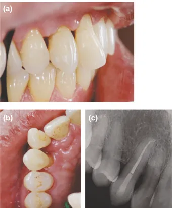 Figure 4. Recall lateral (a), occlusal (b) and radiographic view (c).  