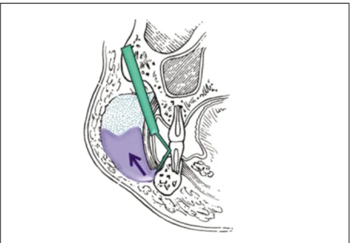 Figure 4. Schematic  of  the  pathogenesis  of  subcutaneous emphysema.