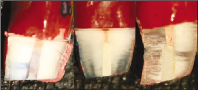 Figure 3. Representative samples of radiograph from each group  with  aluminum  step  wedge  (Left;  MTA  with  6 mmAl, Mid; AMTA with 10 mmAl, and Right; EPPC with 5 mmAl).