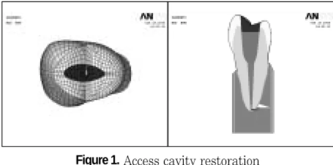 Figure 1. Access cavity restoration 