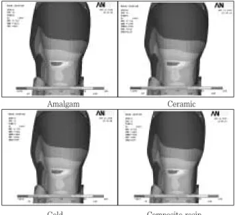 Figure 6. The maximum principal stress of CEJ of palatal surface under Load-1.