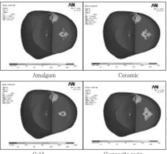 Figure 20. The maximum principal stress distribution along the central groove of occlusal surface under Load-3.