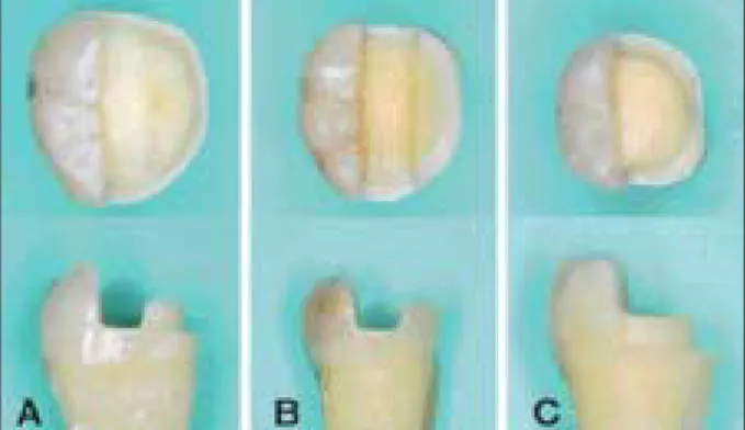 Figure 1. Different tooth preparations suggested for inlays:
