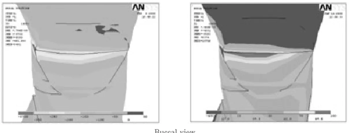 Figure 6.  The compressive and tensile stress distribution on occlusal cavosurface margin (Occlusal), DEJ, lesion apex and CEJ (Apex &amp; CEJ), cervical cavosurface margin (Cervical) under Load B (MP: Mesial point angle, DP: Distal point angle, Mes: Mesia