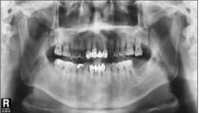 Figure 1.  Normal periapical radiograph of lower right first  premolar  and  first  and  second  molars