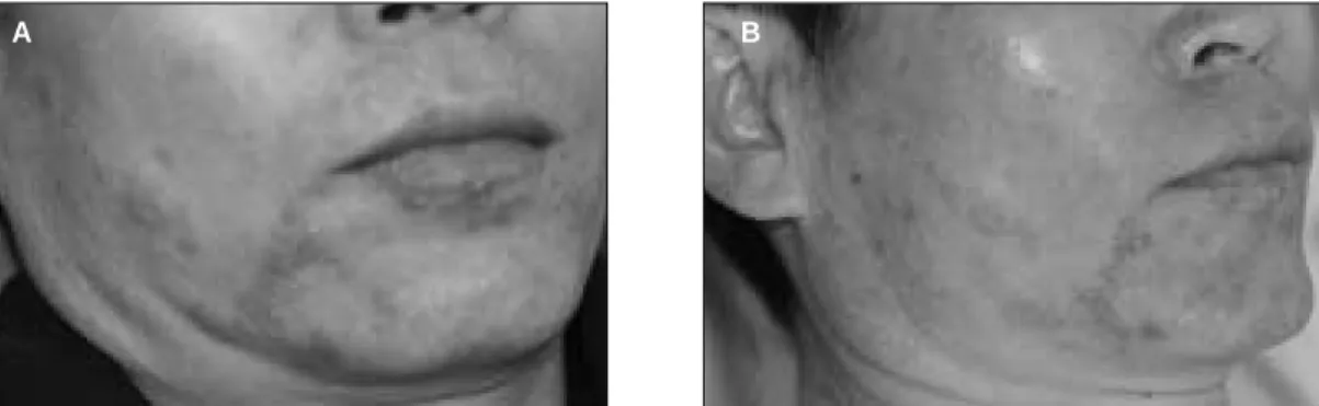 Figure 3. (A) Three days after the initial visit: extraoral lesions or rash show the distribution of the involved nerve