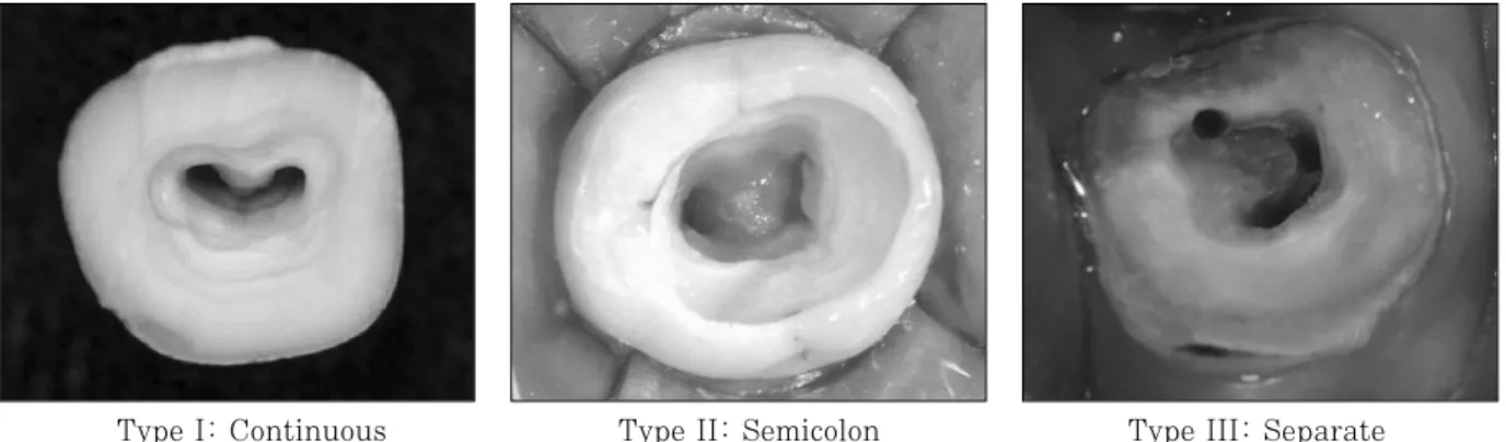 Figure 1. Classification of the C-shaped root canal orifice.
