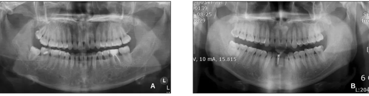 Figure 5.  Frequency of the C-shaped root canal types.