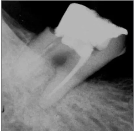 Figure 1.  Diagnostic  intraoral  radiograph  (a).  Separated  file  in  the  mesial  root  isthmus  (b,  c)  and  remove  it  using ultrasonic device under microscope (d).