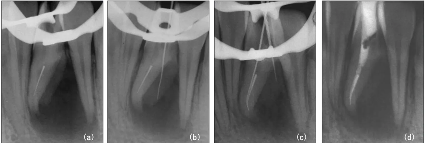 Figure 7. After tooth extraction, C-shaped root apex and root perforation were investigated