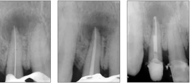 Figure 2-C.   Endodontic treatment.