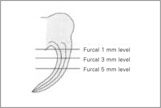 Figure 3.  Computer captured images. A, before root canal instrumentation; B, after canal instrumentation.