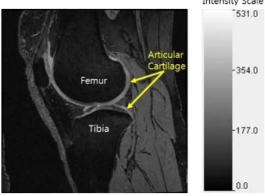 그림 1. 무릎 MR영상 중 관절 연골 Fig. 1. The  articular  cartilage  in  knee  MRI