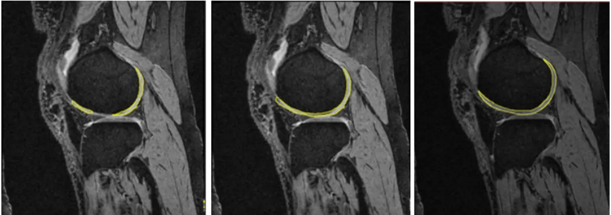 Fig. 4. Performance  comparison  between  ball  kernel  and  Gaussian  kernel  :  femural  cartilage  segmentation(left)  and  tibial  cartilage  segmentation(right)
