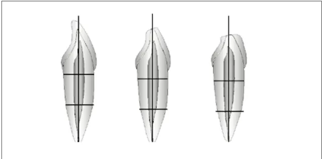 Fig. 1. Ideal access placement and incisal wear