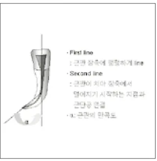 Table 1. The Relationship between ideal access placement and incisal wear                                             (n=200)