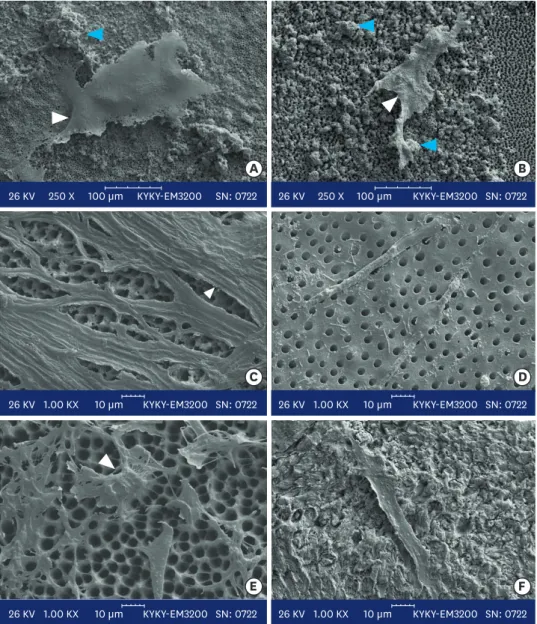 Figure 2. Scanning electron micrographs of calcium-enriched mixture cement (left column) with (A) 0.1 mm, (C)  0.3 mm, and (E) 0.5 mm dentin thicknesses and mineral trioxide aggregate cement (right column) with (B) 0.1  mm, (D) 0.3 mm, and (F) 0.5 mm denti