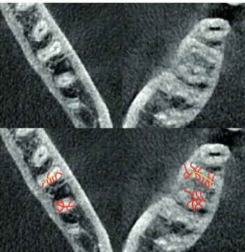 Figure 1. An example of accessory canals. In the bottom image, the main (yellow) and accessory (red) canals  are marked.