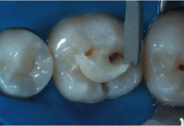 Figure 4. After phosphoric acid and adhesive layer placed, Bulk Fill composite resin as placed in the cavity with  one increment.