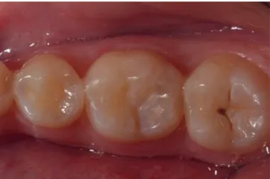 Figure 7. Composite Bulk Fill Restoration placed after finishing and polishing procedures.