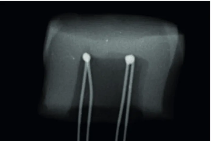 Figure 1. Radiograph showing thermocouples inside pulp chamber.