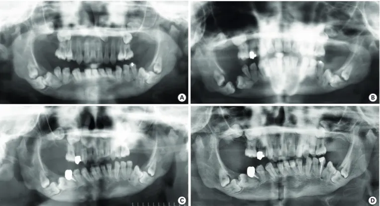 Figure 1. A preoperative panoramic view (A). A panoramic view of 2nd visit (B). A panoramic view after marsupialization of dentigerous cyst on teeth #46 and 