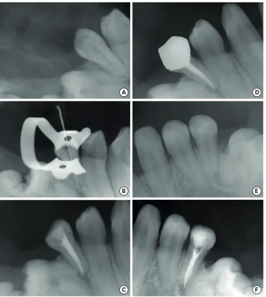 Figure 3. A preoperative radiograph of the tooth #45 (A). A radiograph of the tooth #45 with initial apical file (B)