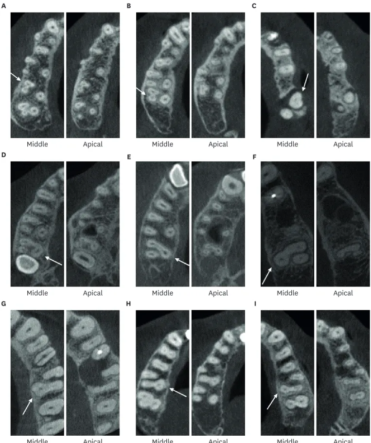 Figure 1. Maxillary first and second molars, fused root type 1, 2 and 3. (A-C) Variations of type 1 root fusion (MB-DB roots) (arrows); (D-F) Variations of type 2 root  fusion (MB-P roots) (arrows); (G-I) Variations of type 3 root fusion (DB-P roots) (arro