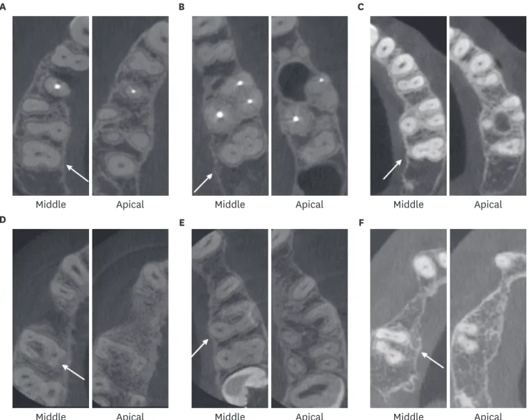 Figure 3. Maxillary first and second molars, fused root type 6 and not catalogued. (A-C) Variations of type 6 root fusion (single root, cone-shape root) (arrows); 