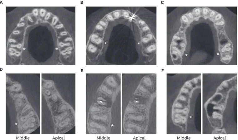 Figure 4. Maxillary first and second molars, symmetry and fusion in adjacent molars. (A-C) Examples of symmetry ( * ) between right and left maxillary molars
